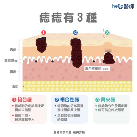 身體很多痣|為什麼臉上的痣越來越多？皮膚科醫師解析長痣原因、。